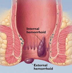 tipos-hemorroides