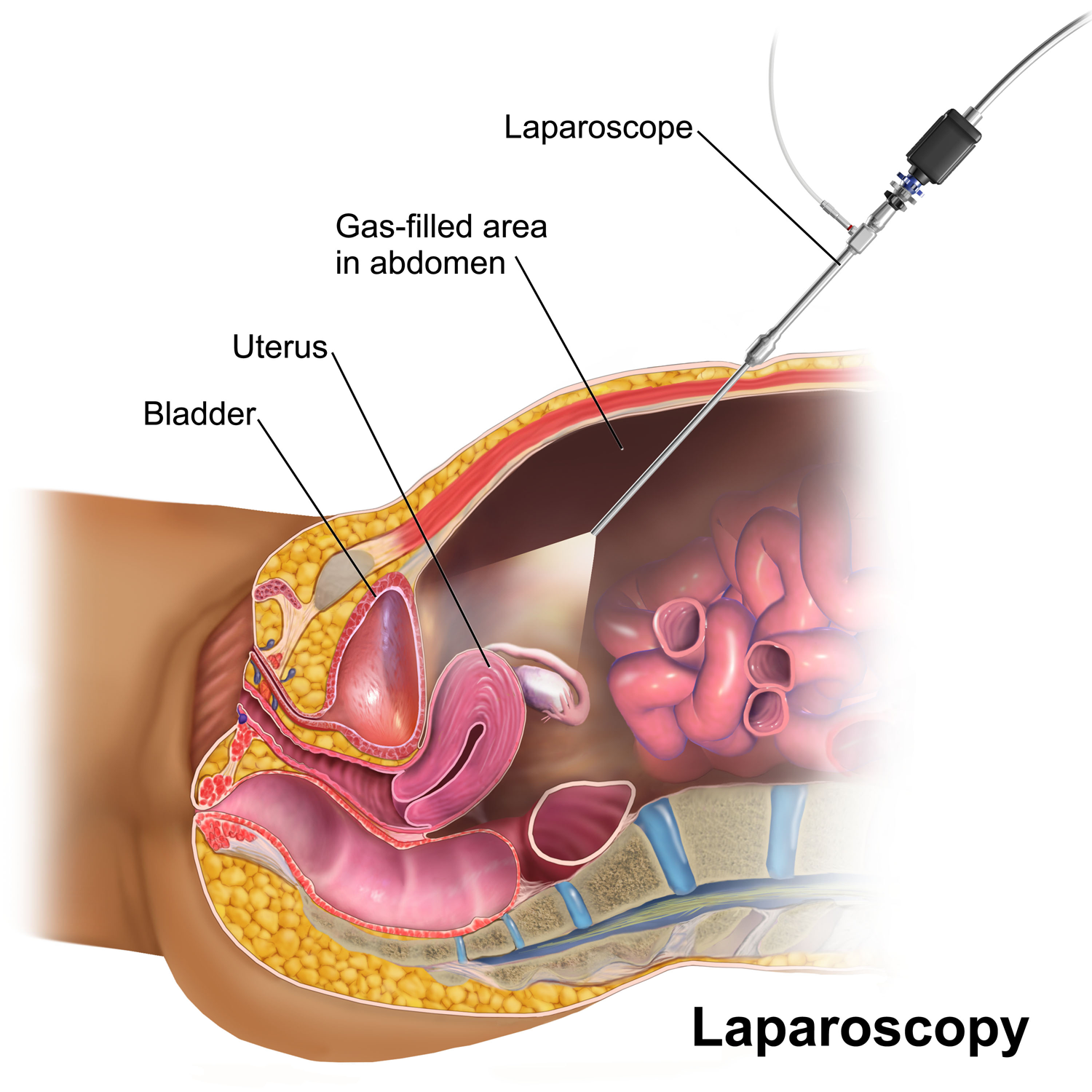 cirugia-laparoscopia-alicante