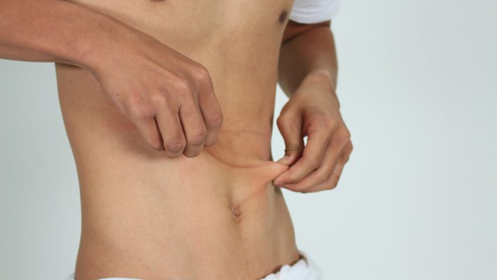 Qué es la diverticulosis Qué es la diverticulosis